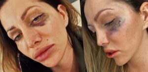 Miroslava Fabušová monokel zbitá napadnutá útok